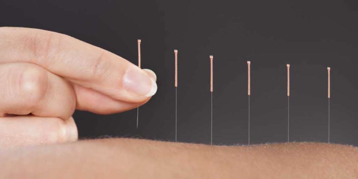 Exploring the Healing Power of Acupuncture: A Journey into Traditional Chinese Medicine