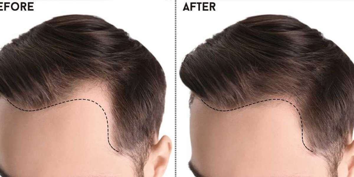 Reviving Confidence: The Definitive Guide to Hair Transplant in Pakistan