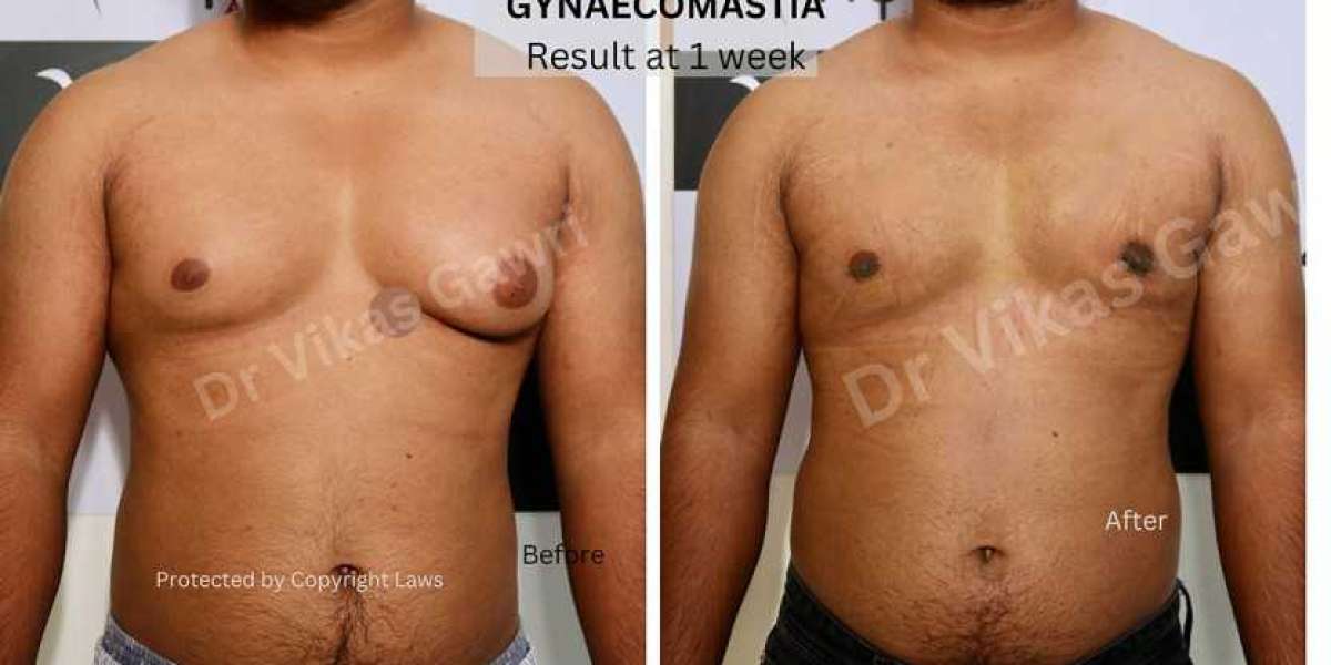 Gynaecomastia Surgery Punjab: Achieve a Confident and Sculpted Chest at Kyra Clinic