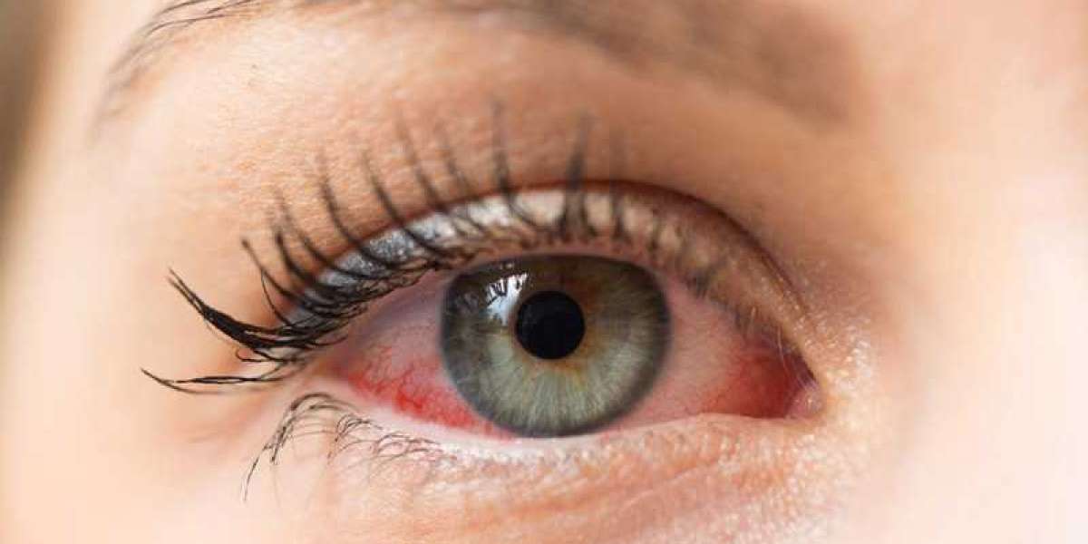 Exploring Advanced Dry Eyes Treatments: From Artificial Tears to Punctal Plugs