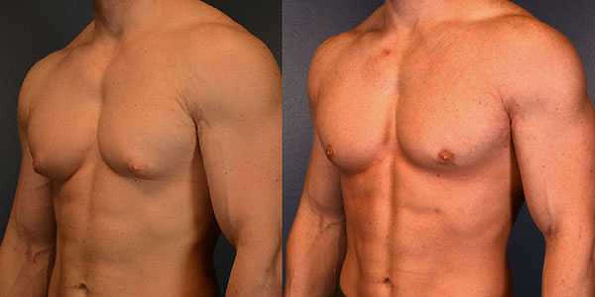 Understanding Breast Tissue and Fat Removal in Gynecomastia Surgery
