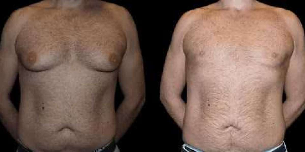 Understanding the Risks and Complications of Male Breast Reduction in Dubai