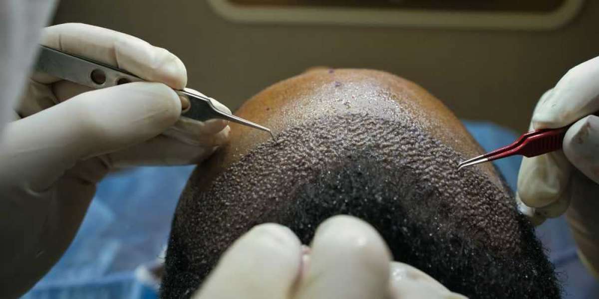 Non-Surgical Hair Transplant in Lahore: Affordable Solutions for Hair Restoration