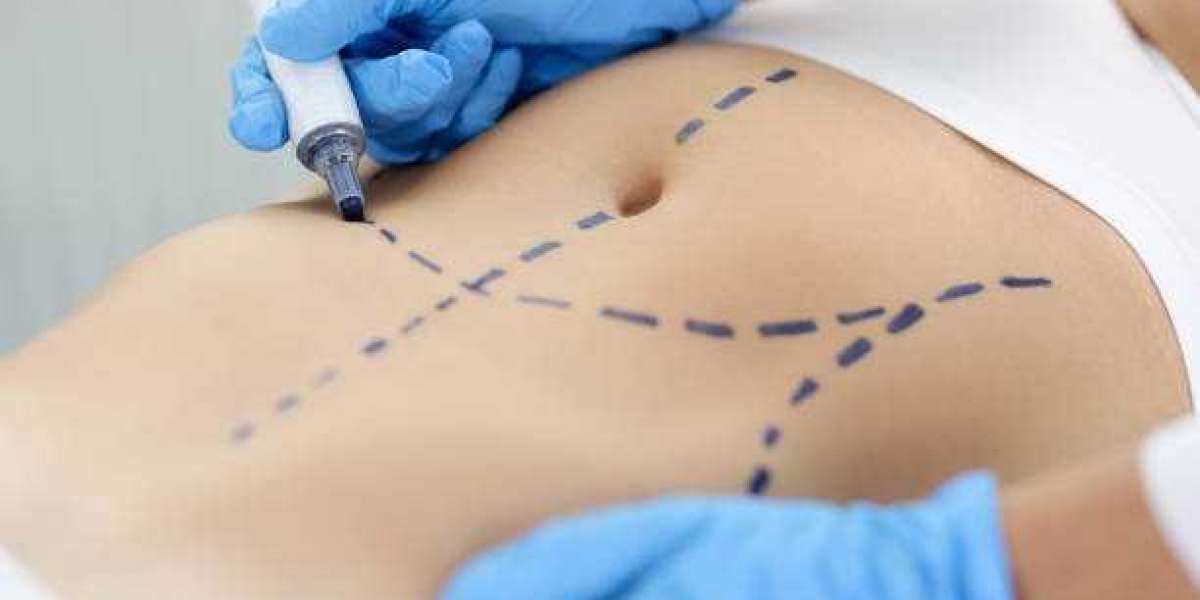 "Unlock a New You: A Comprehensive Look at Tummy Tuck Treatments"