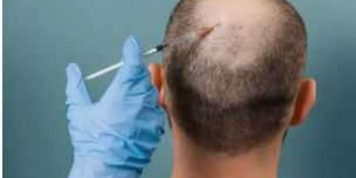 Decoding the Investment: Understanding the Average Cost of FUE Hair Transplant in London