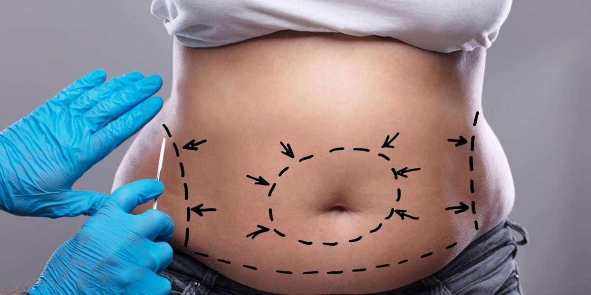 Long-Term Effects of Tummy Tuck Surgery: Insights from the Best Surgeon in Dubai