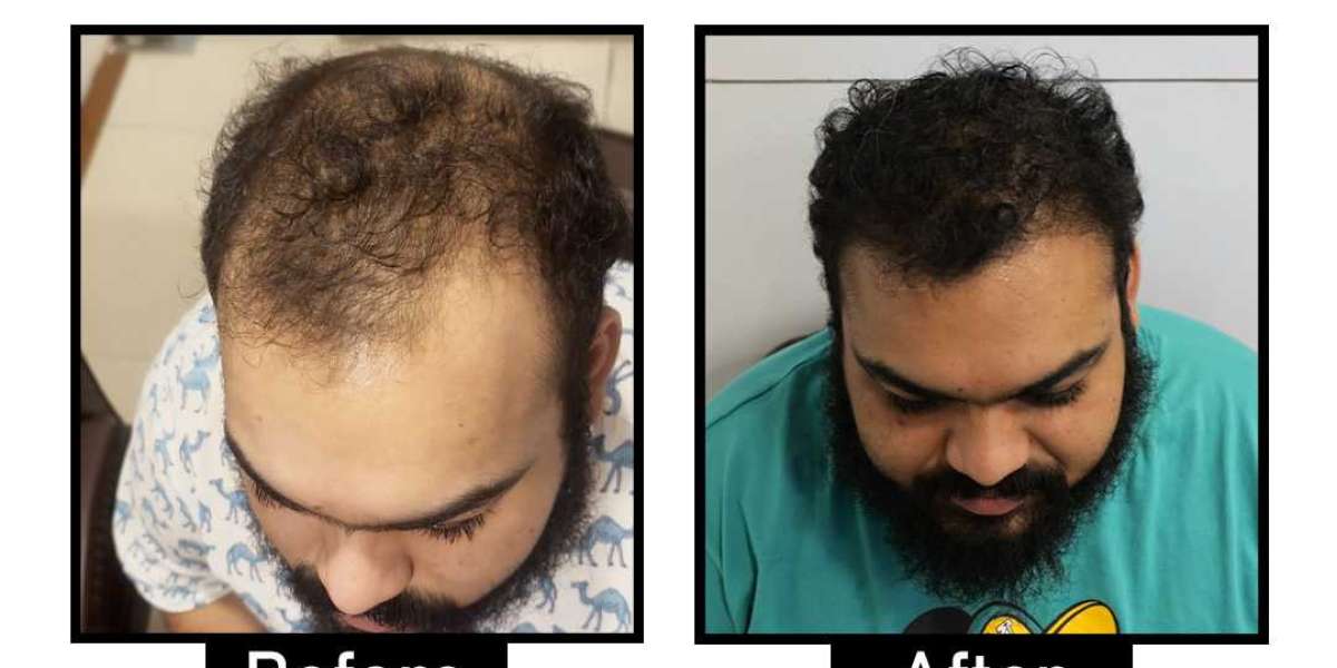 Best Hair Transplant in Delhi: Costs, Techniques, and Clinics