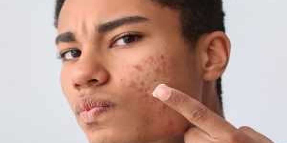 Is Isotretinoin (Accutane) Safe for Acne Treatment?