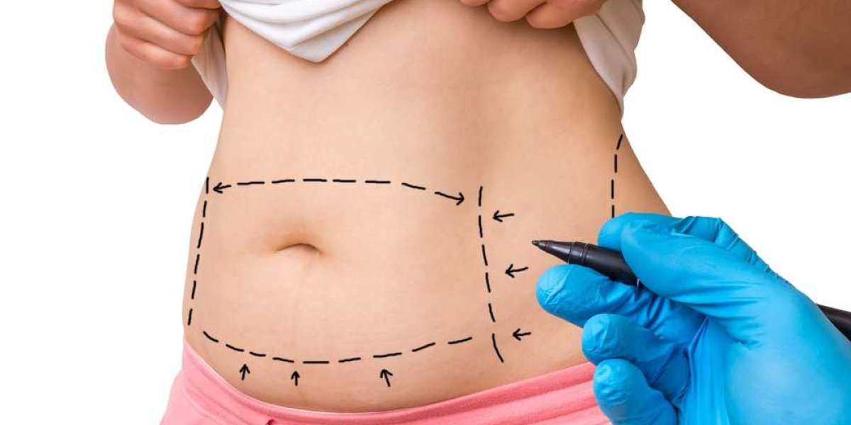 Long-Term Effects of Tummy Tuck Surgery: Insights from the Best Tummy Tuck Surgeon in Dubai