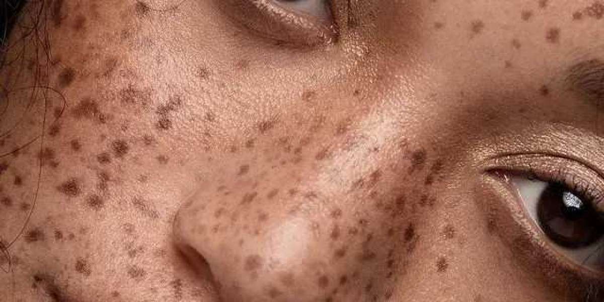 Is Dermal Pigmentation Reversible? Islamabad Experts Weigh In