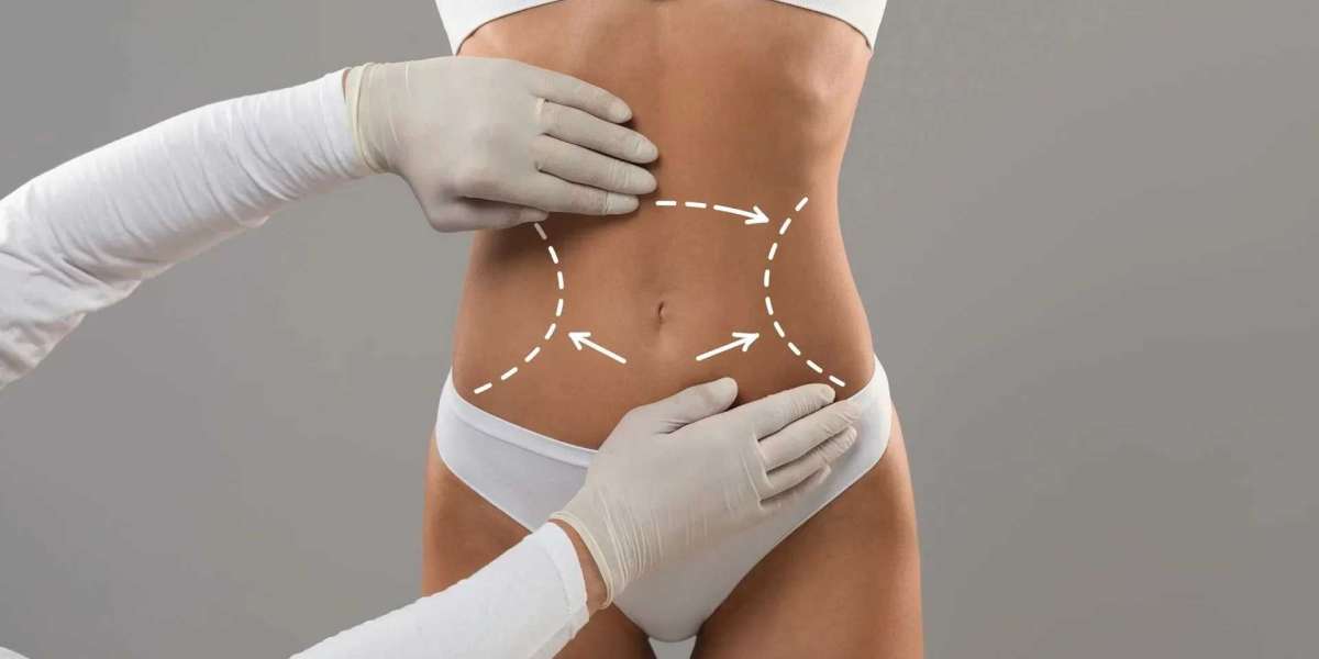 The Ultimate Guide to Liposuction in Islamabad: What You Need to Know