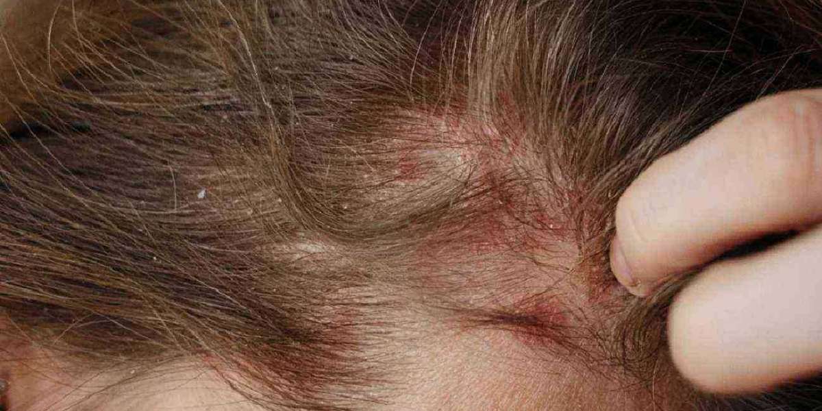 Eczema and Hair Follicles: The Science Behind Hair Loss