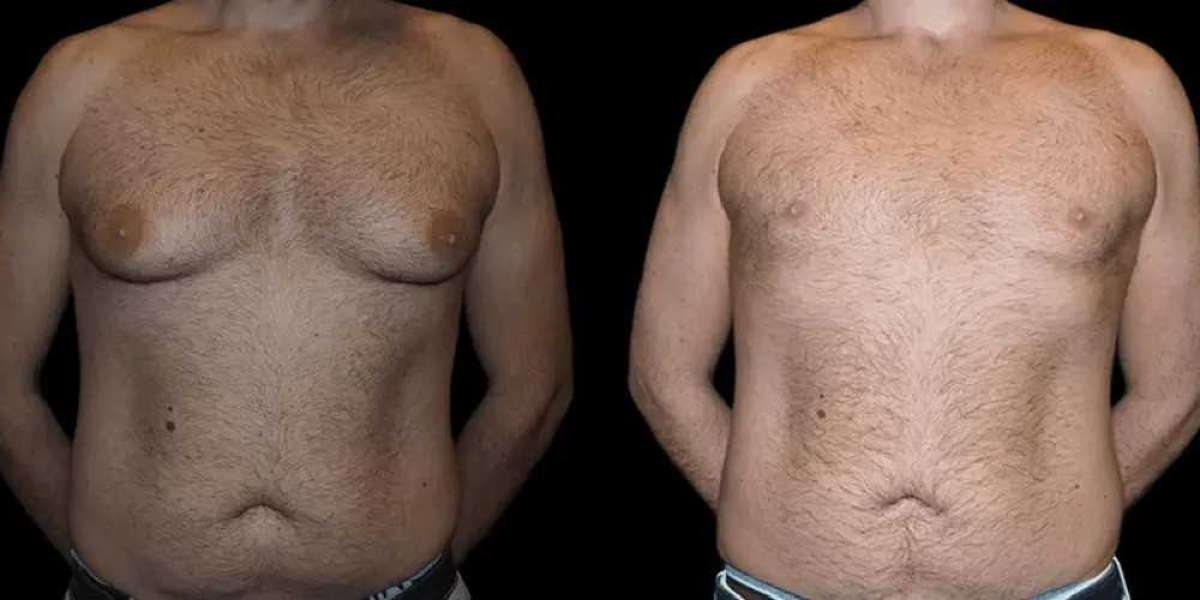 Gynecomastia in Dubai: Your Guide to Male Breast Reduction