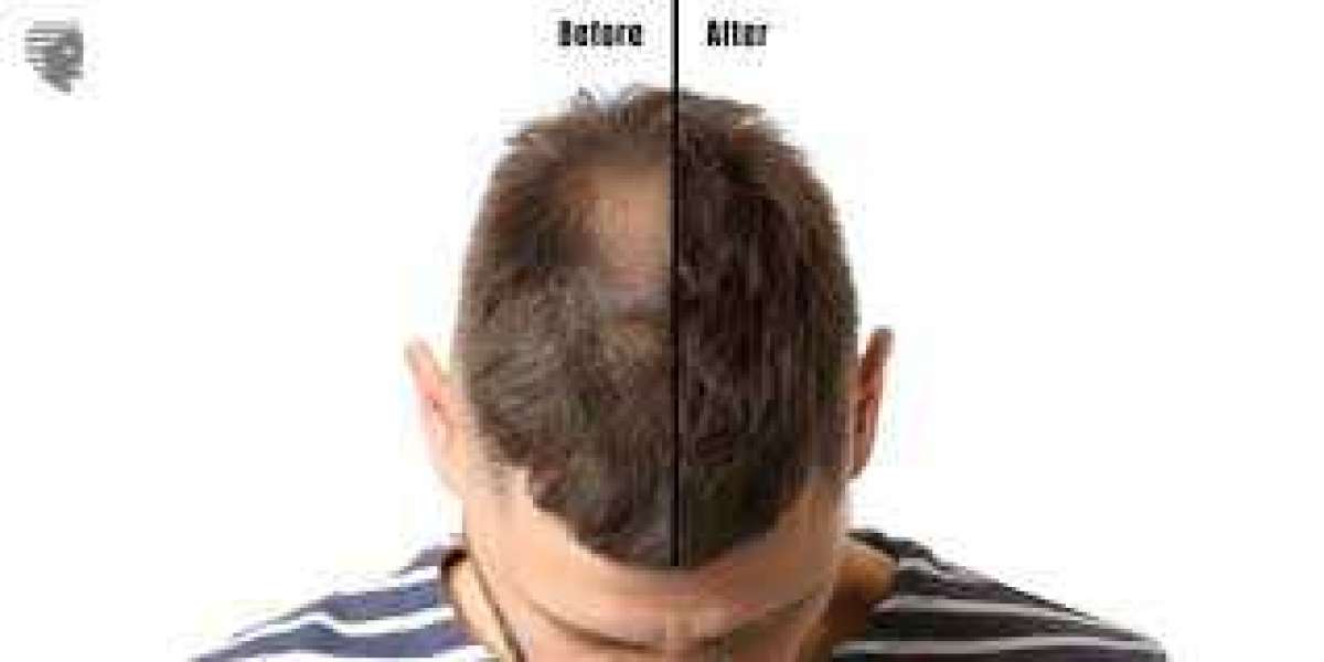 Comprehensive Guide to Hair Replacement in Toronto