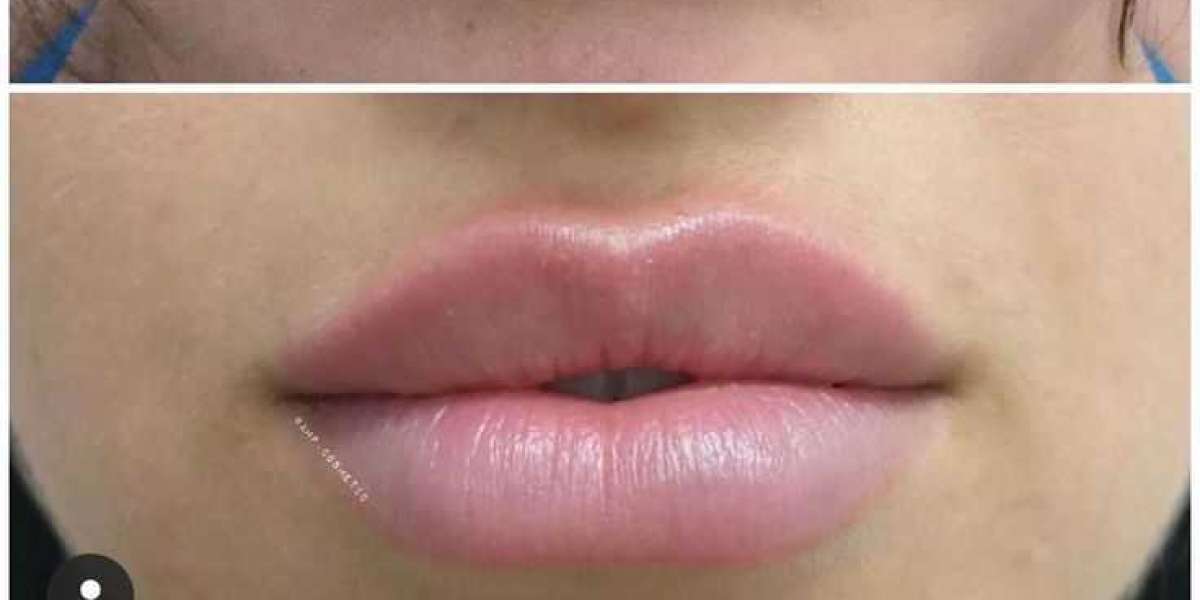 Transform Your Smile: The Power of Professional Lip Treatment