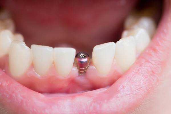 dental implants Chippenham