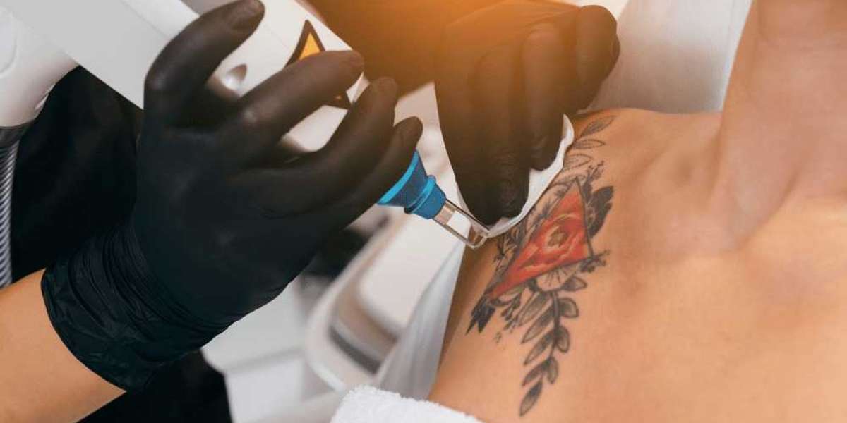 Laser Tattoo Removal Near Me Altamonte Springs