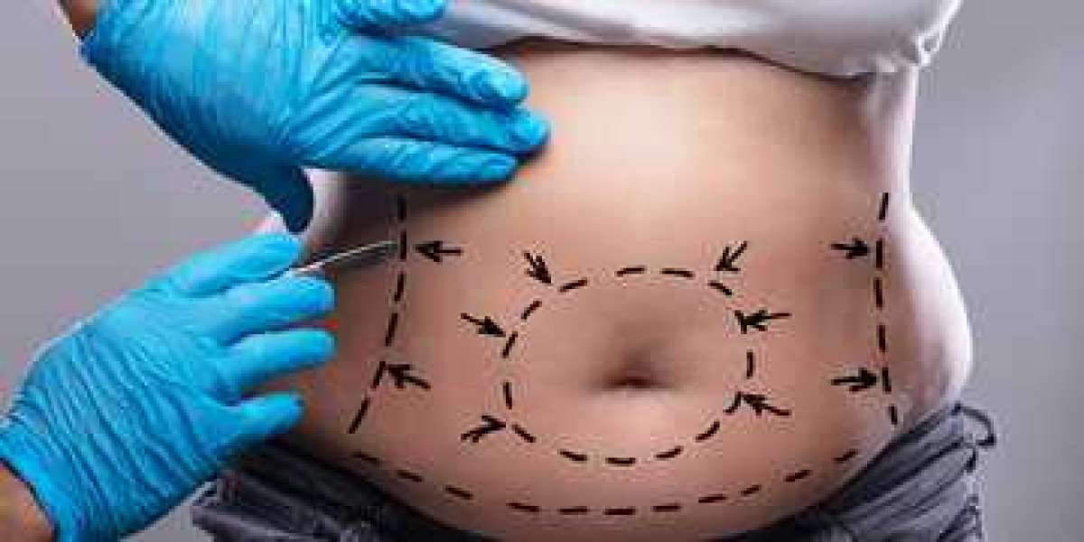Can a Mini Tummy Tuck in Dubai Help With Skin Folds After Weight Loss?